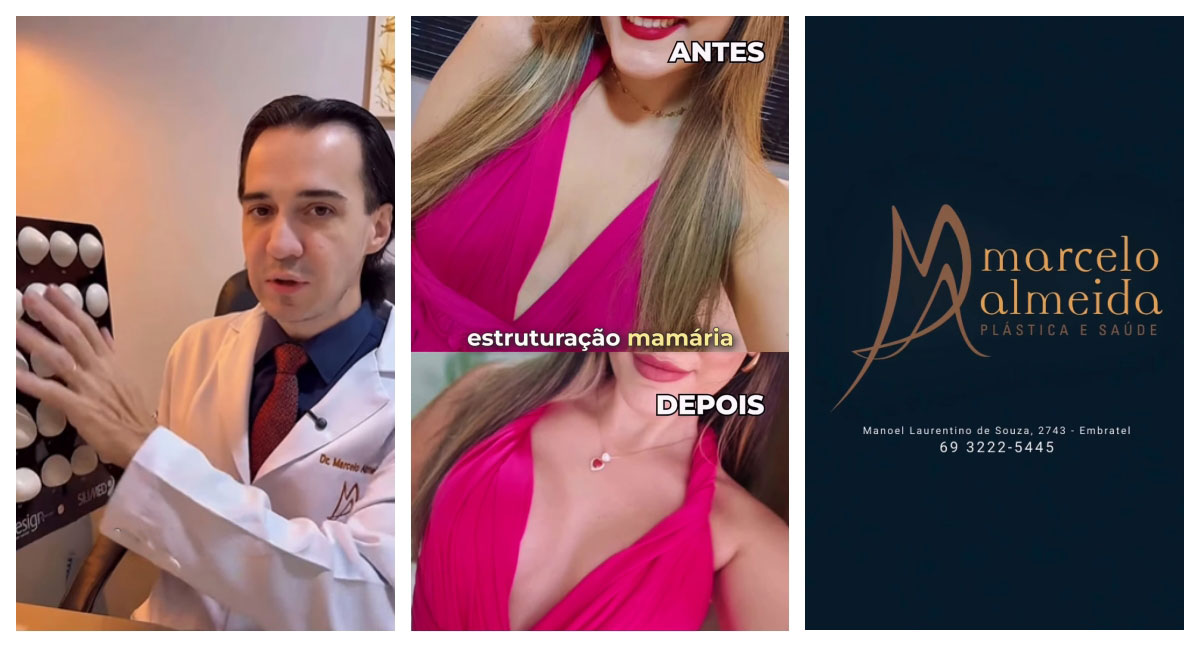 Dr. Marcelo Almeida explica: prótese de mama ideal vai além do tamanho
