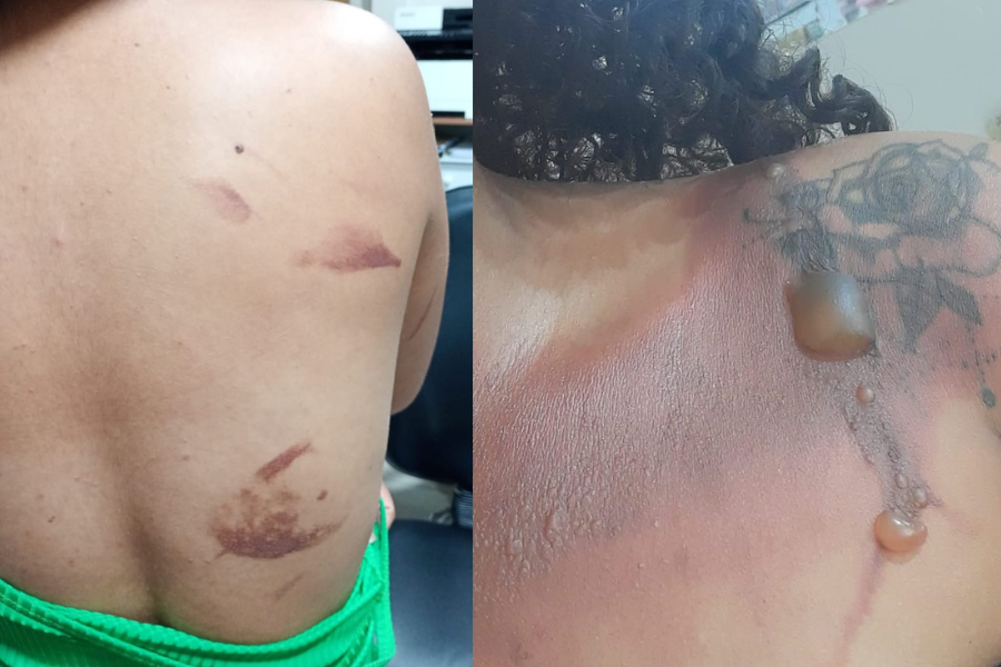 Mulher é atacada com água quente pelo companheiro em Parauapebas