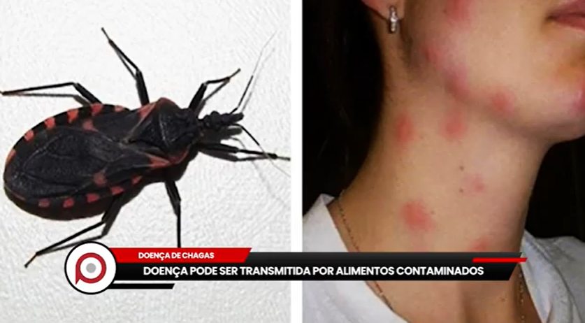 Doença de chagas pode ser transmitida por alimentos contaminados