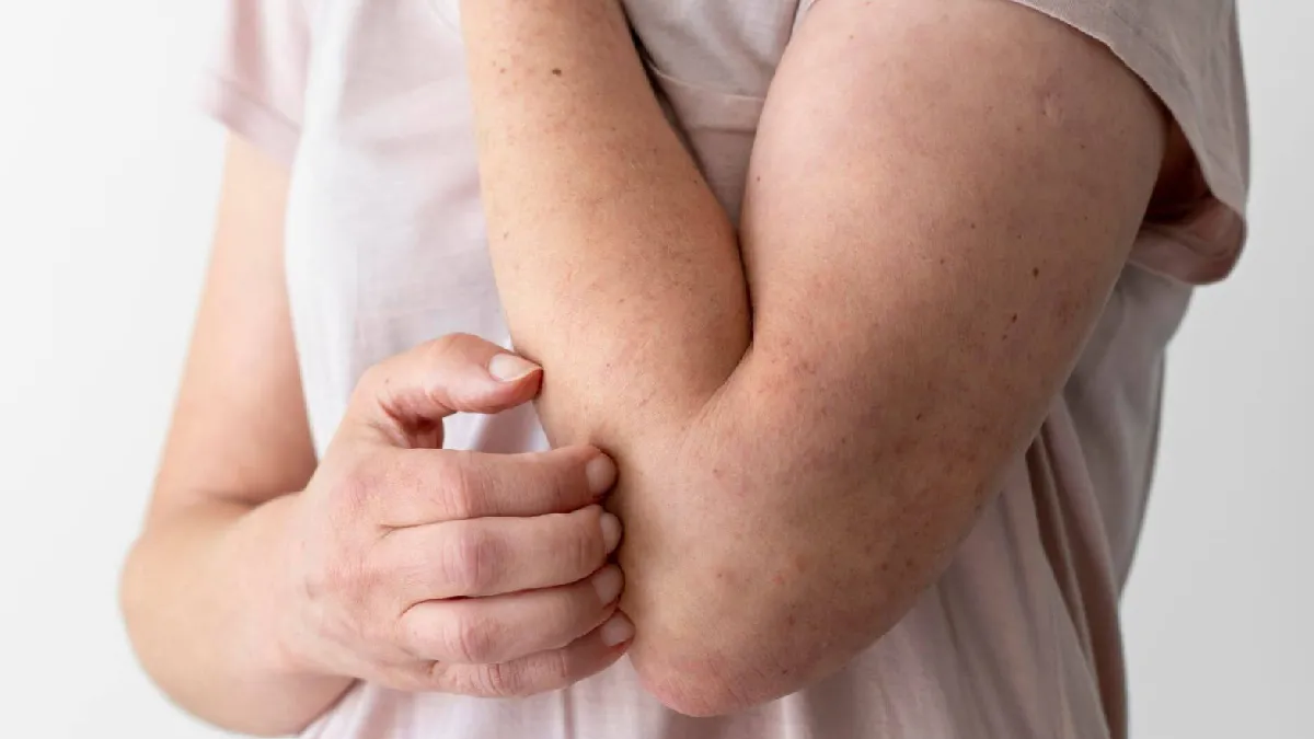 Diagnóstico tardio: Acre tem alto índice de sequelas graves de hanseníase