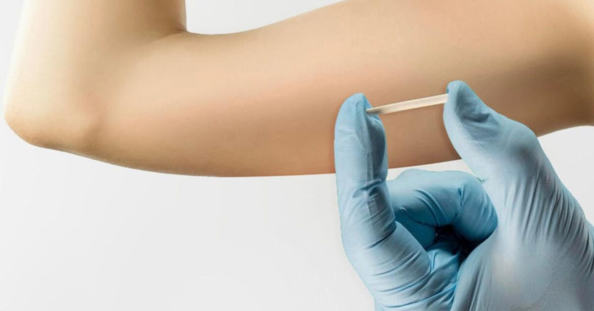 Implantes hormonais exigem cautela em mulheres com lipedema; saiba mais