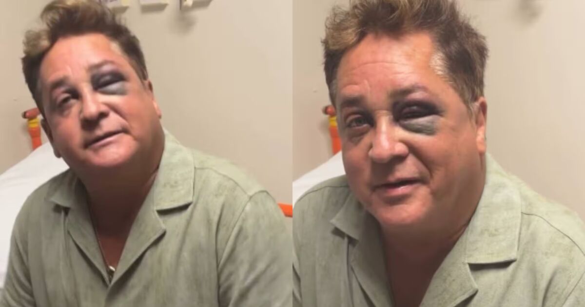 Leonardo surge com olho roxo após queda e vai parar no hospital