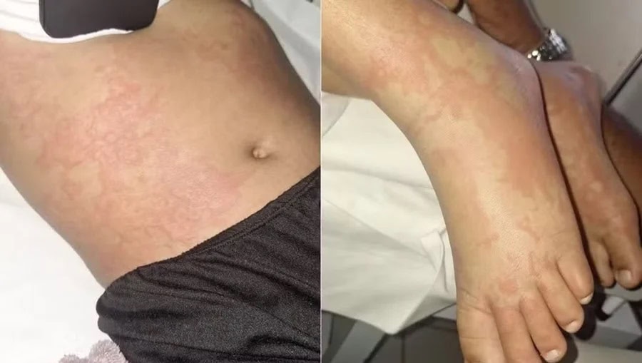 Menina de 10 anos luta contra infecção após contato com detergente Ypê