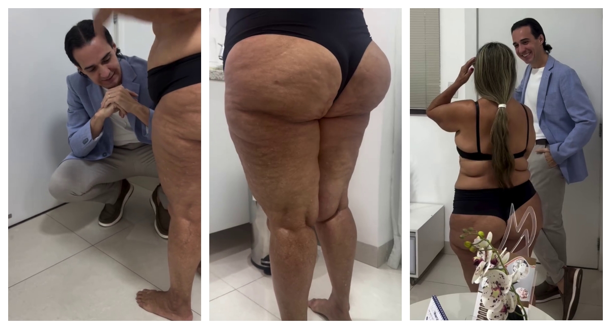 Dr. Marcelo Almeida alerta: lipedema exige diagnóstico e tratamento adequado