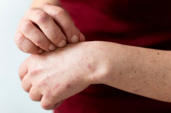 Semana Mundial da Alergia alerta para prevenção e diagnóstico