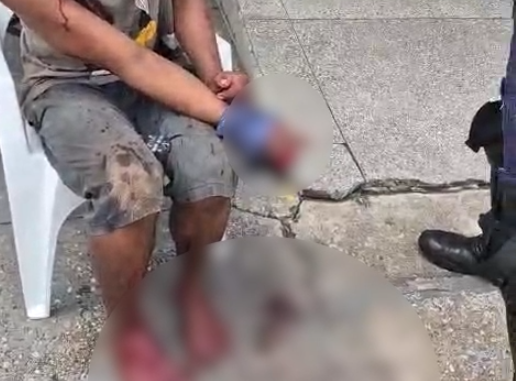 homem tem dedos cortados após tentativa de roubo na Compensa